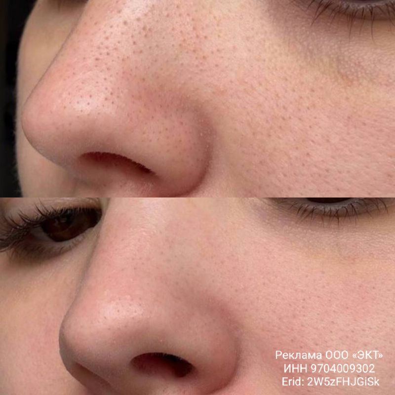 Энзимная пудра: новое слово в уходе за кожей на даче