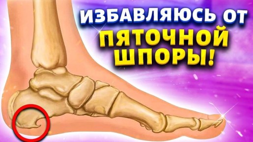 Не отчаивайтесь, если страдаете от шпоры на пятке