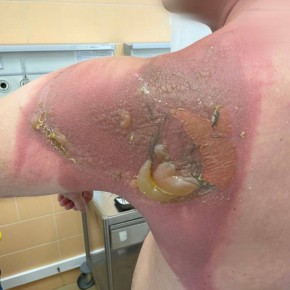 В Татарстане мужчина попал в больницу с химическим ожогом 2 степени