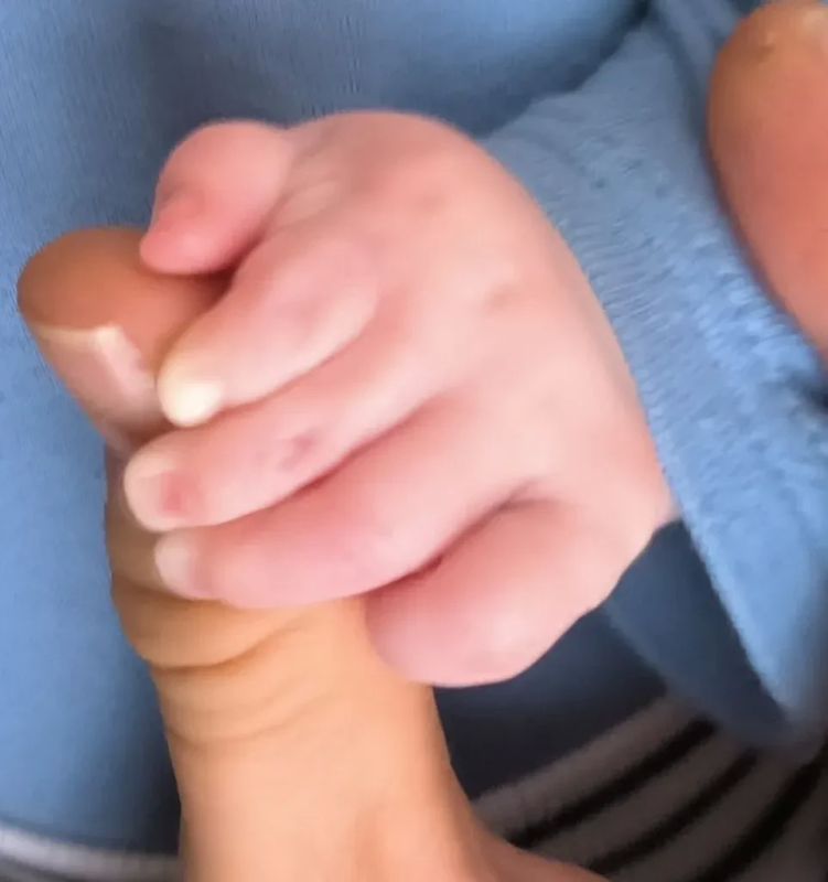 В Клиниках СамГМУ ребёнку со сращением пальцев вернули полноценную работу кисти В Клиниках СамГМУ ребёнку со сращением пальцев вернули полноценную работу кисти