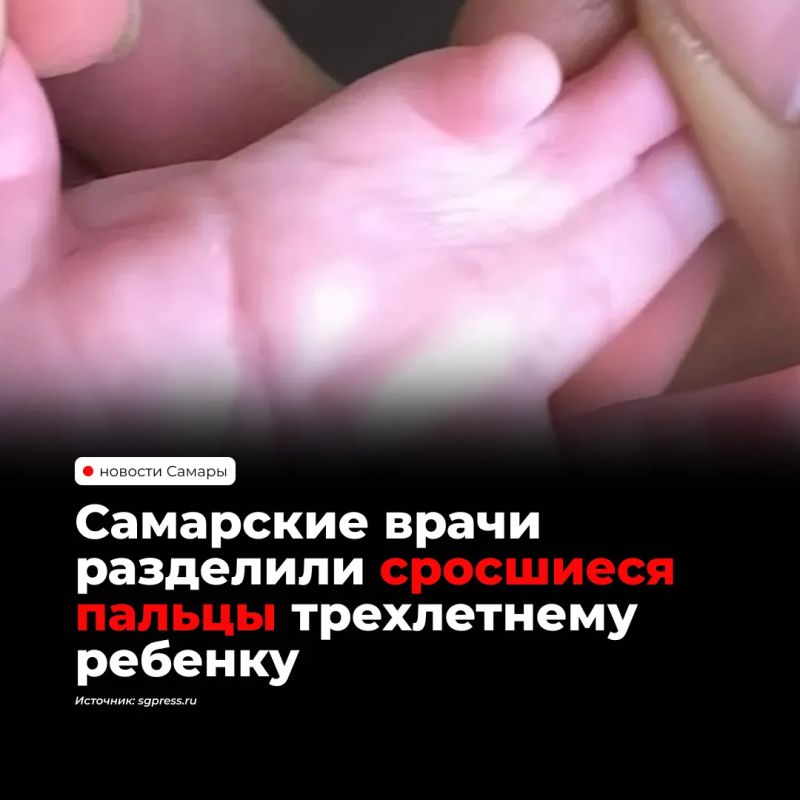 Самарские хирурги клиники СамГМУ успешно разделили сросшиеся пальцы на обеих руках ребенка — лечение заняло четыре операции с зимы 2024 года, когда малышу было полгода
