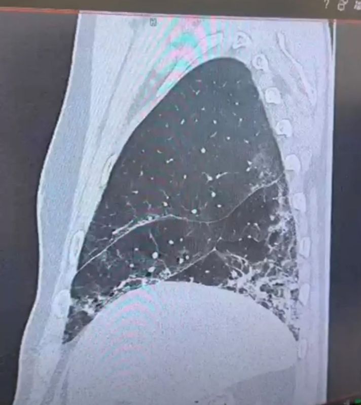 «Мои легкие как будто в два раза уменьшились»: самарец надышался парами бензина до поражения легких «Мои легкие как будто в два раза уменьшились»: самарец надышался парами бензина до поражения легких