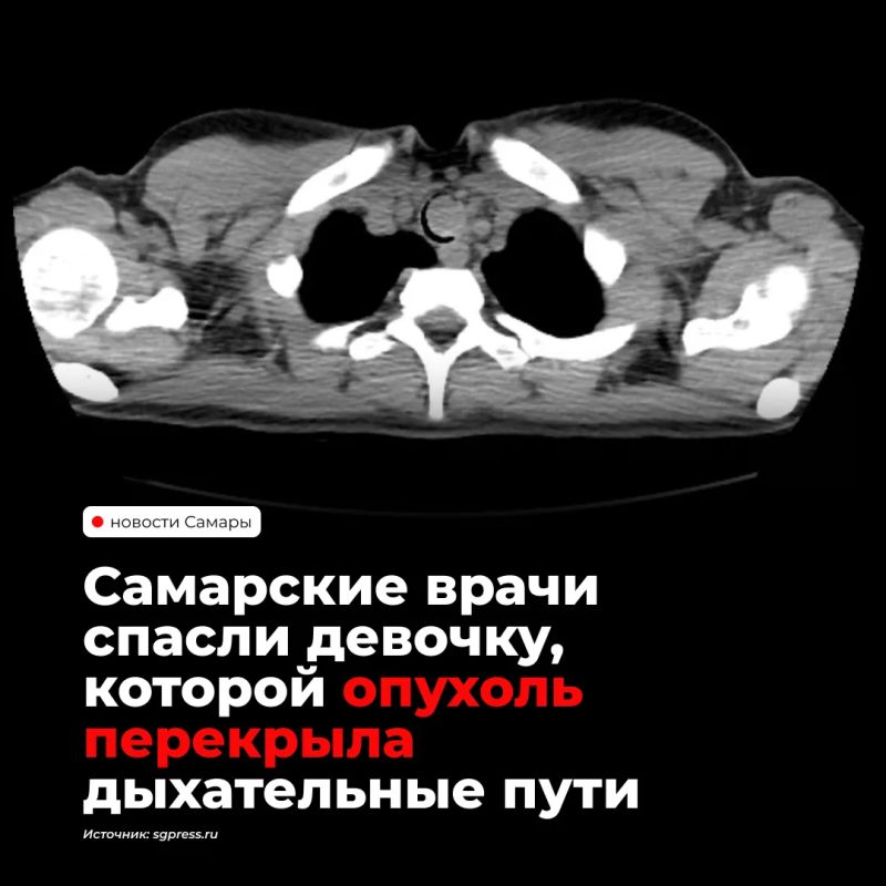 В Самарской областной детской больнице 15-летней пациентке удалили редкую доброкачественную опухоль трахеи